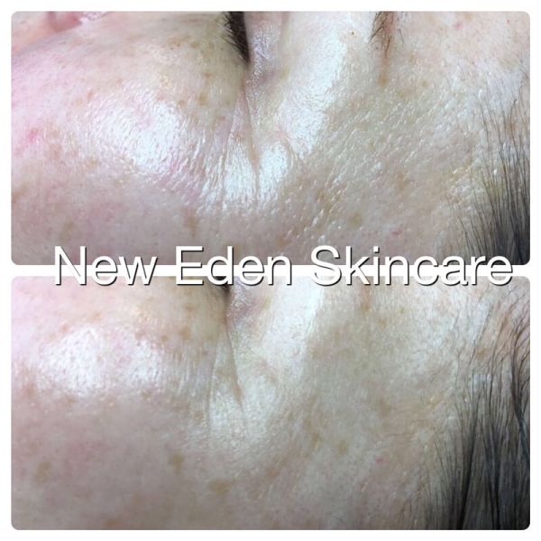 Na 3 Weken Minder Rimpels met Cosmedix & De Peeling bij New Eden Skincare 13 voor en na peeling cosmedix