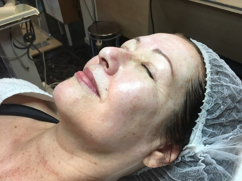 Na 3 Weken Minder Rimpels met Cosmedix & De Peeling bij New Eden Skincare 2 voor peeling cosmedix