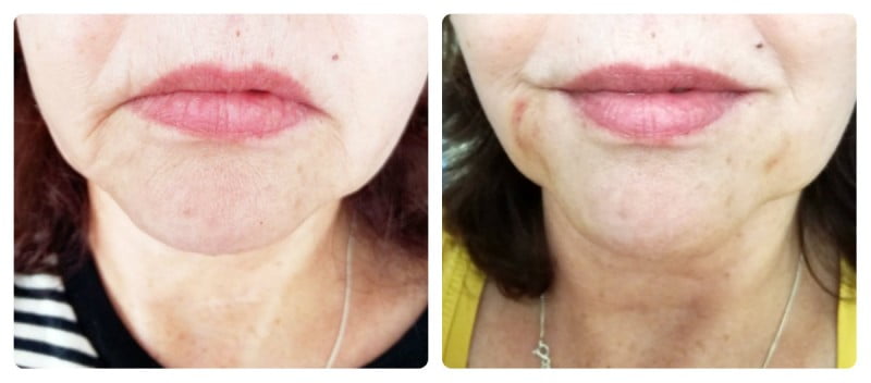 Ik won een Full Face Botox behandeling! Maar... kreeg ik Botox? 7 collage voor en na fillers